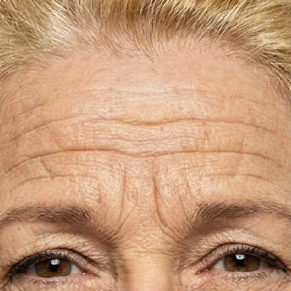 Forehead wrinkles