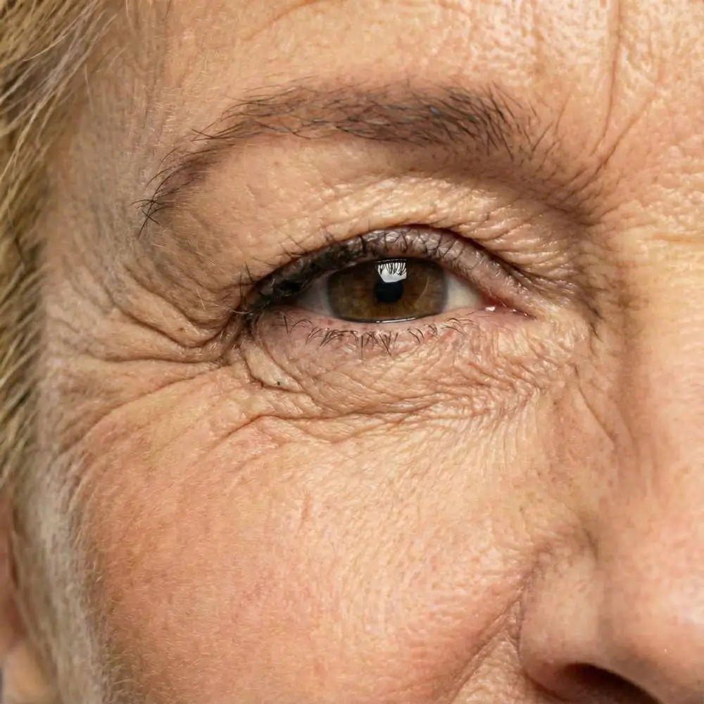 Eye wrinkles or crow's feet