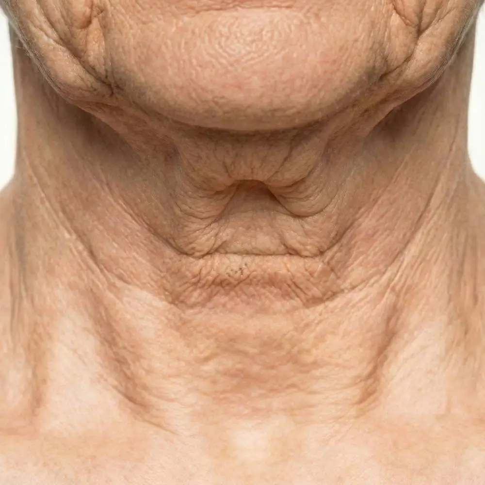Neck wrinkles & sagging jawline