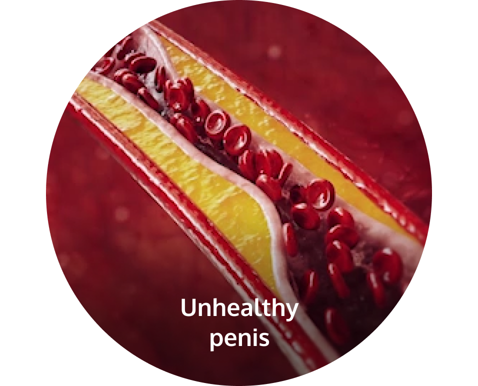 Unhealthy penis, internal view