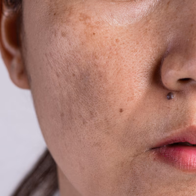 <strong>Dark spots, uneven skin</strong>