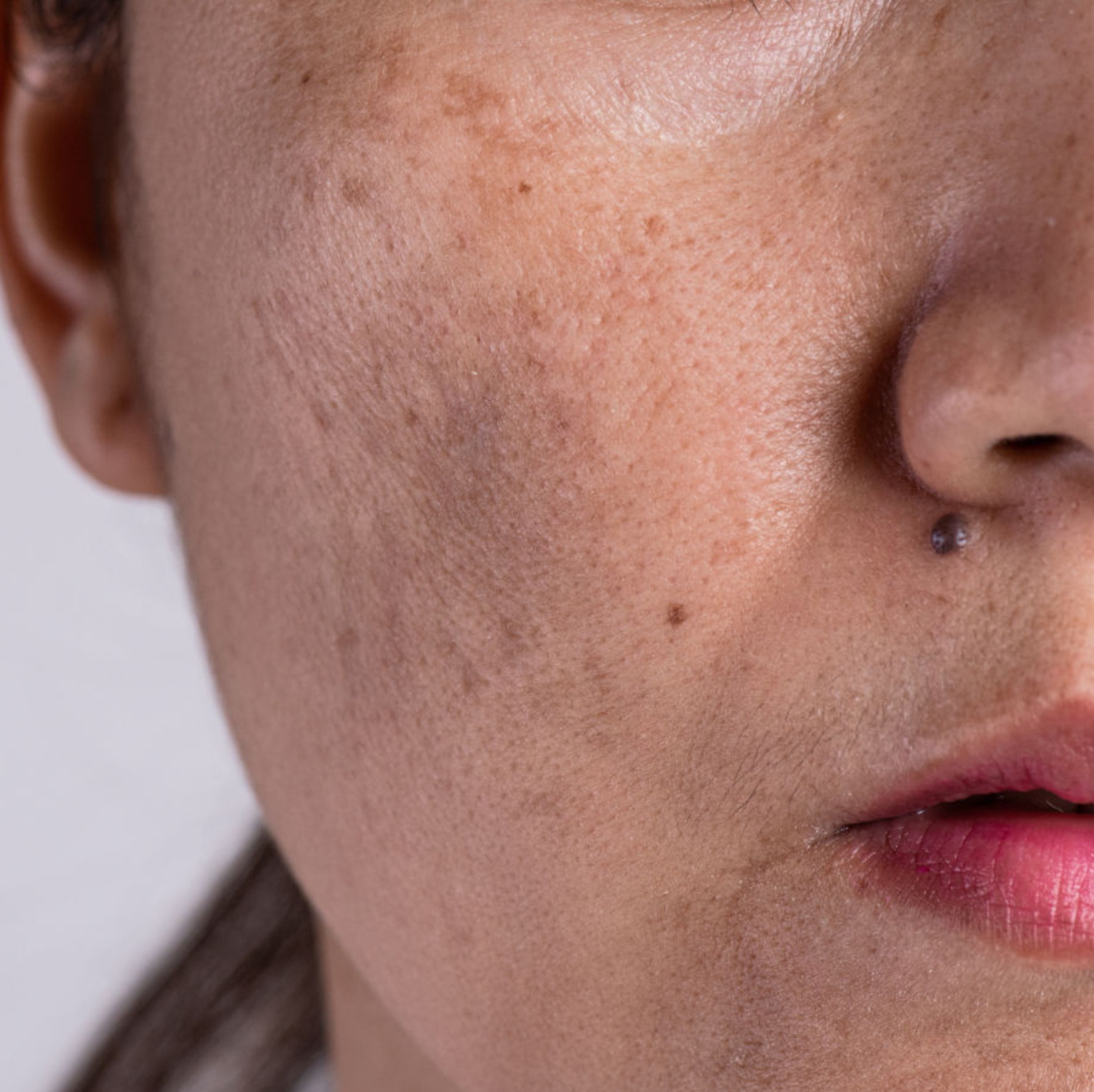 Dark spots, uneven skin