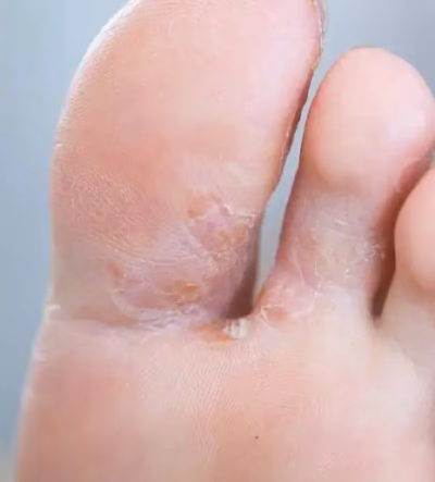 Itching or burning between the toes