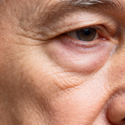 Poches sous les yeux & cernes